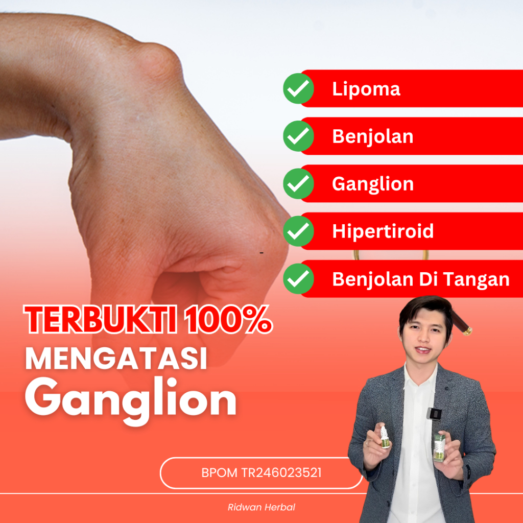 Obat Kista Ganglion, Benjolan Di Tangan, Benjolan Lunak / Keras Di Telapak Tangan, Mengecilkan Kista