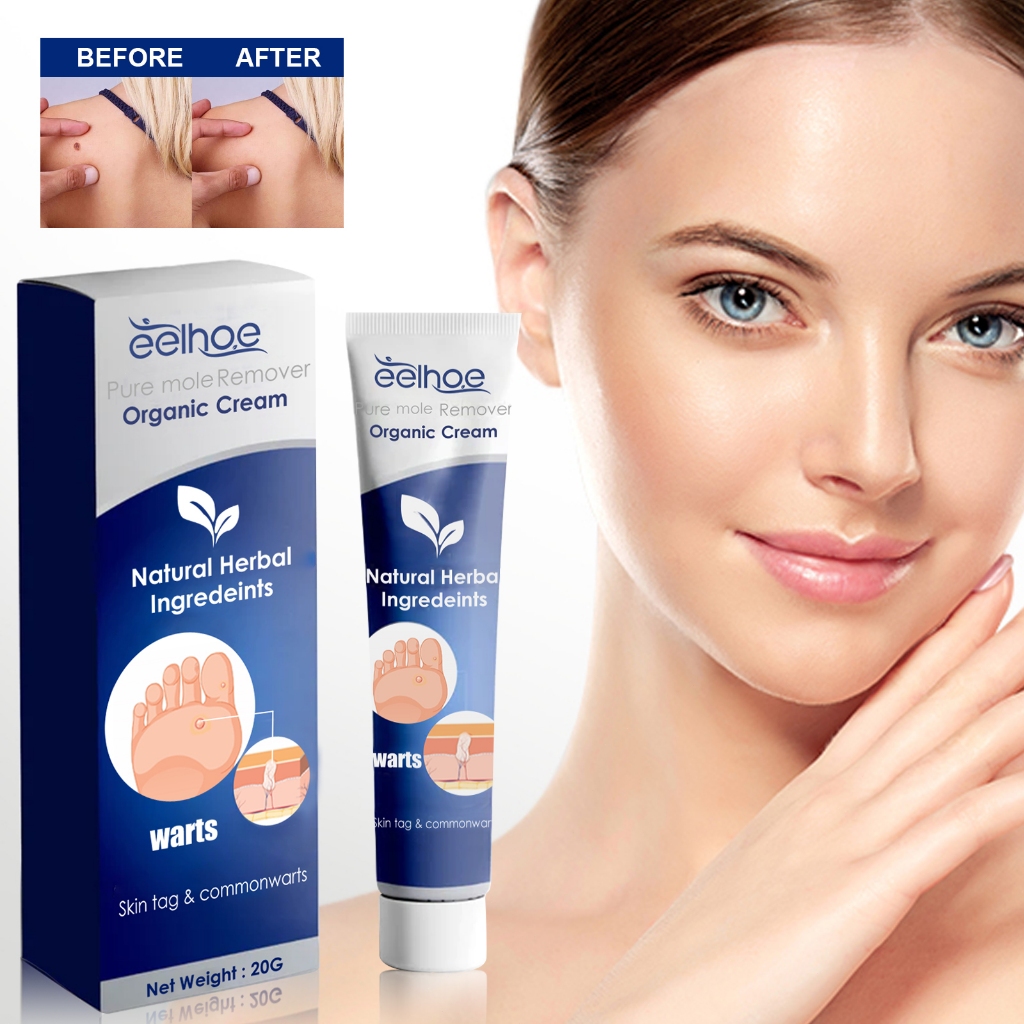 EELHOE Penghilang Kutil Pasta 20g Penghilang Kutil Dan Tahi Lalat Penghilang Kutil Ampuh Perawatan T