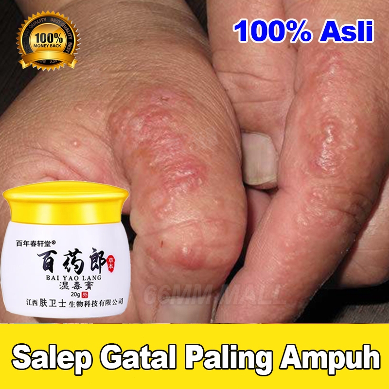 Salep Eksim Kering dan Gatal Salep Gatal China Paling Ampuh Obat Gatal Selangkangan Salep Bayi Untuk