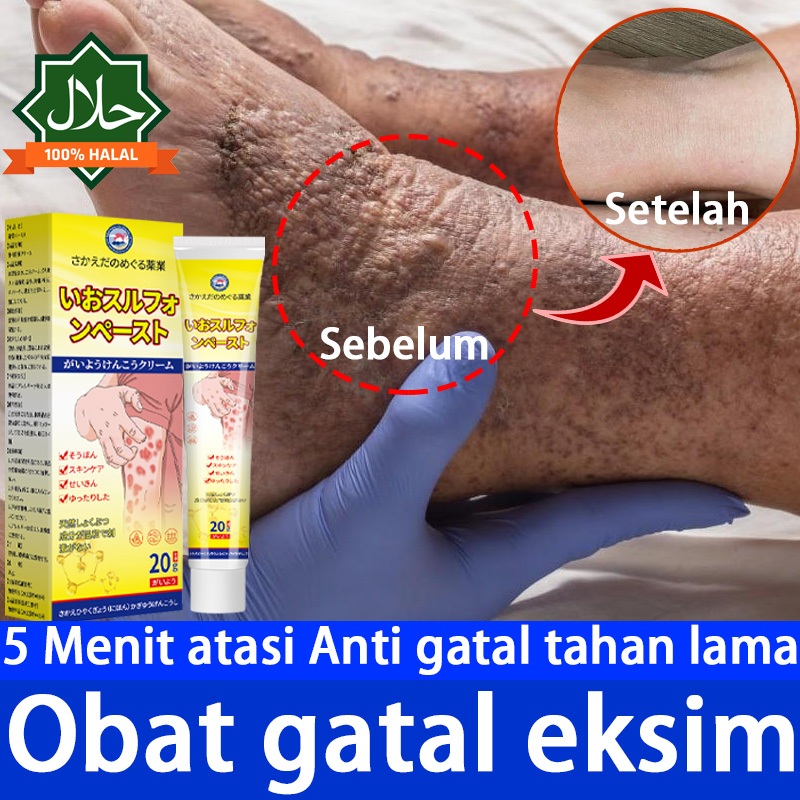 Salep Eksim Salep gatal Salep psoriasis Saleb gatal paling ampuh Digunakan untuk meredakan bagian pr