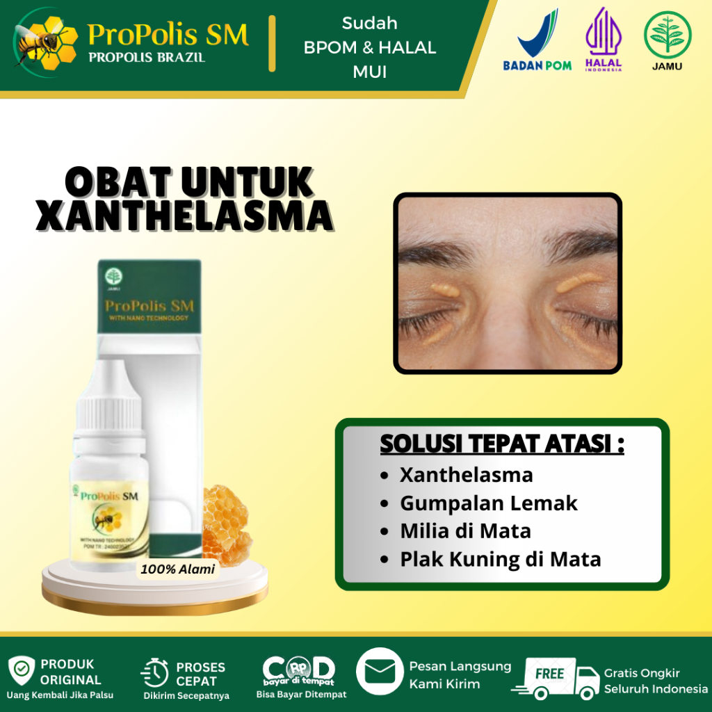 Obat Xanthelasma Di kelopak Mata, Penghilang Gumpalan Lemak Di Kelopak Mata, Kuning Kuning Di Kelopa
