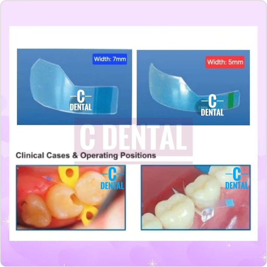 [1 Piece] Dental Posterior Proximal Matrix Transparan Strip