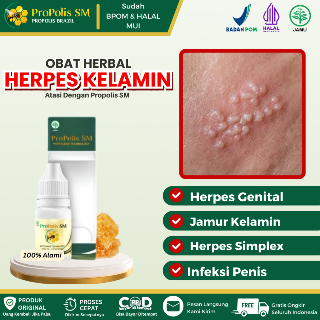 Propolis SM - Obat Herpes Kelamin, Herpes Genital, Jamur Kelamin, Herpes Zoster, Herpes Simplex, Rua