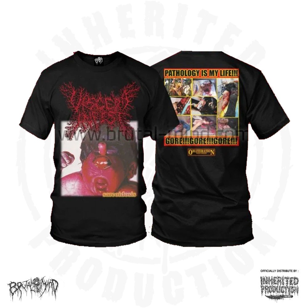 TS - viscera infest - sarcoidosis