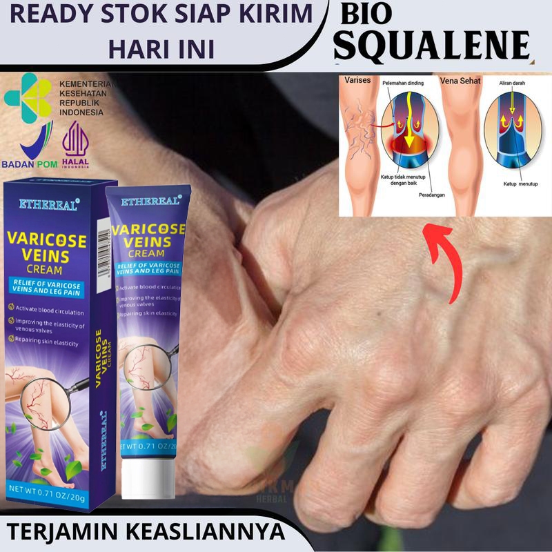 Varicose Veins Cream 20g obat varises di kaki dan betis paling ampuh salep varises Ampuh Tanpa Opera