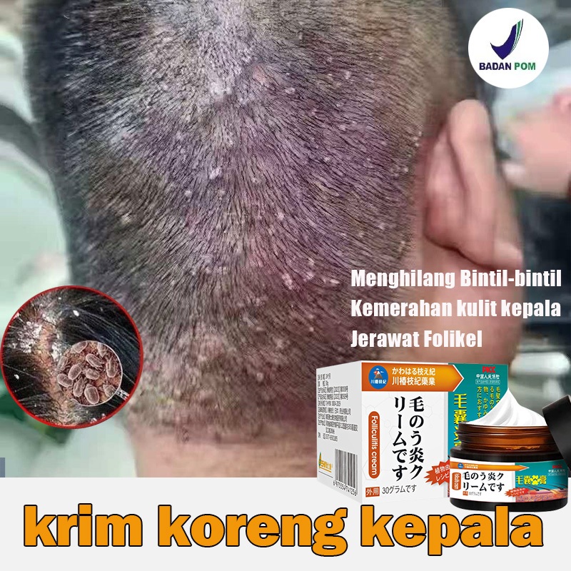 obat folikulitis kepala obat kepala gatal Krim Psoriasis salep 30g ketokonazol ketokonazol jerawat b