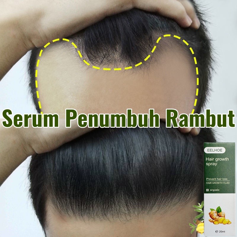 Penumbuh Rambut Botak Tonik Rambut Rontok Ampuh Menumbuhkan Rambut Botak Scalp Essence Pertumbuhan R