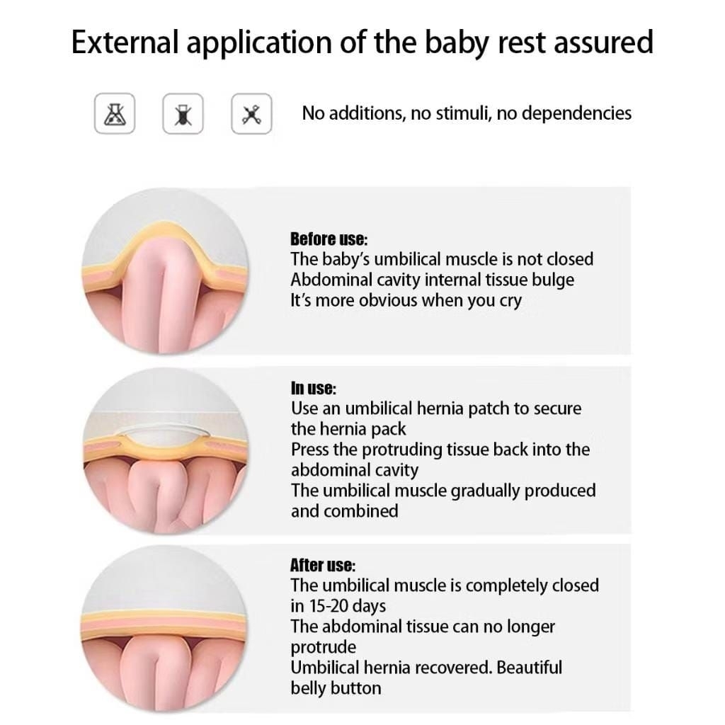 HERNIA ANAK PATCH / SABUK HERNIA / PUSAR BODONG ANAK