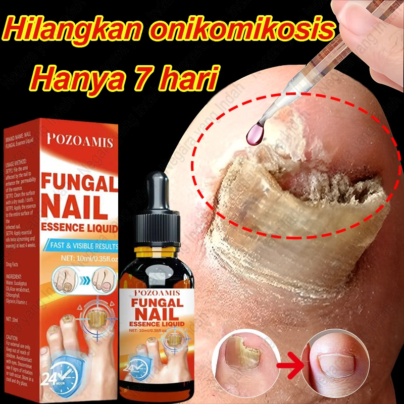 [Impor dari Amerika Serikat]Serum Perbaikan penghilang jamur kuku,Hilangkan jamur kuku dengan cepat,