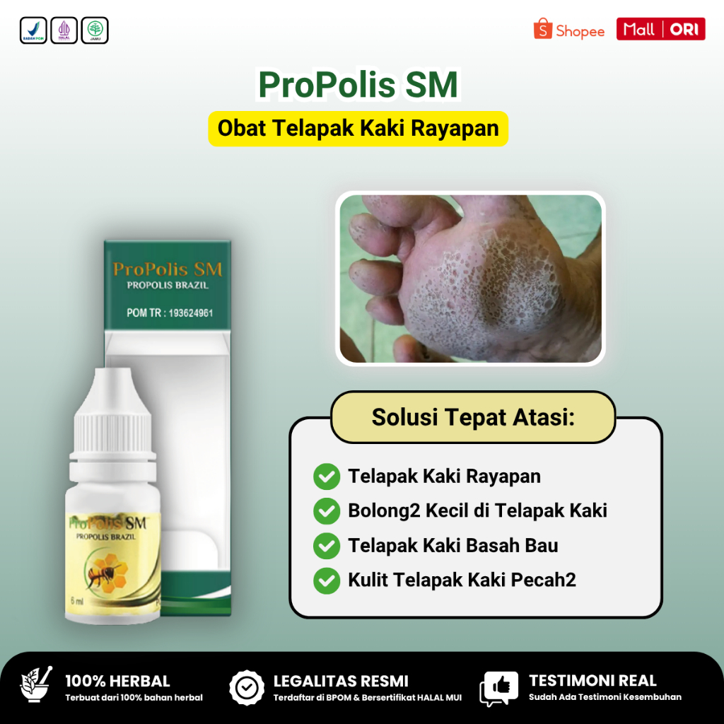Obat Kaki Rayapan, Penghilang Bolong Bolong Kecil di Telapak Kaki Rayapan - Propolis SM