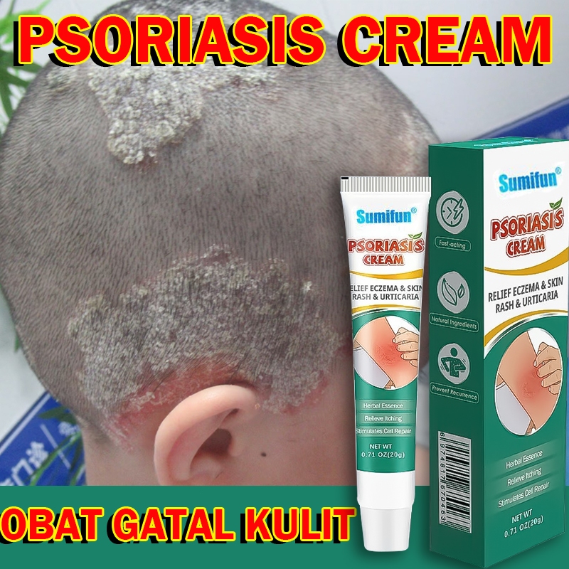 Sumifun Psoriasis Cream Relief Eczema Skin Rash & Urticaria Obat Kurap & Panu Cepat Hilang dalam 7 H