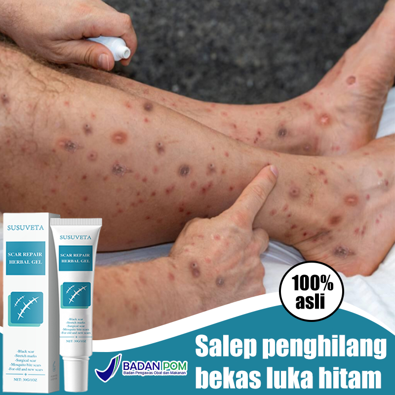 Penghilang bekas luka hitam koreng salep penghilang bekas luka salep keloid paling ampuh 30g salep p