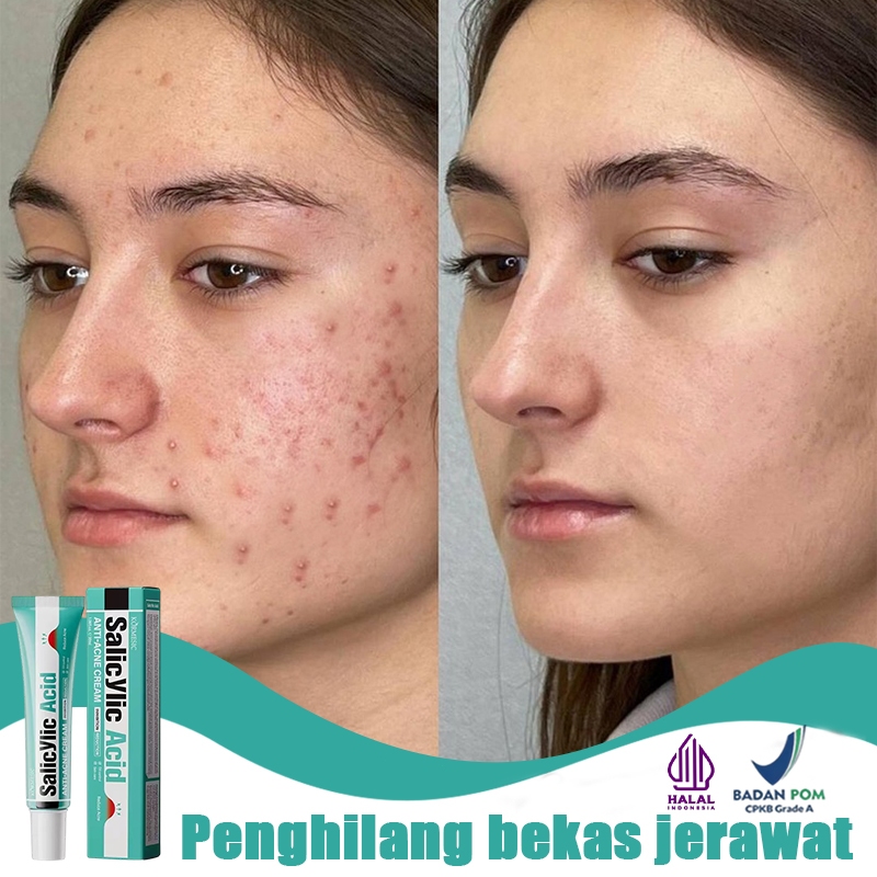 Asam salisilat obat totol jerawat obat jerawat penghilang bekas jerawat salep jerawat paling ampuh 3