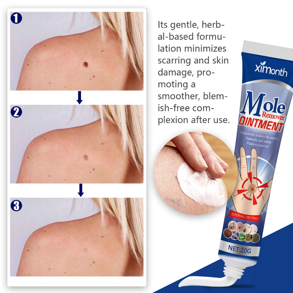 Ximonth Mole Remover Dintment 20g Krim Penghilang Kutil Tanpa Rasa Sakit, Penghilang Tahi Lalat Yang