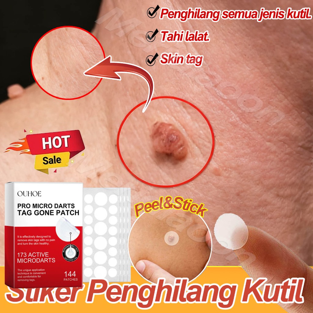 Wart Removal Patch Stiker Penghilang Kutil Dan Tahi Lalat Skin Tag Remover Patch Penghilang Kutil Di