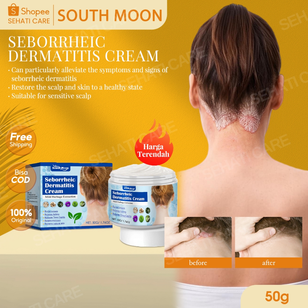 South Moon Seborrheic Dermatitis Cream 50g Reduces Tinea Capitis Herbal Anti-itch Relief  Krim Kulit