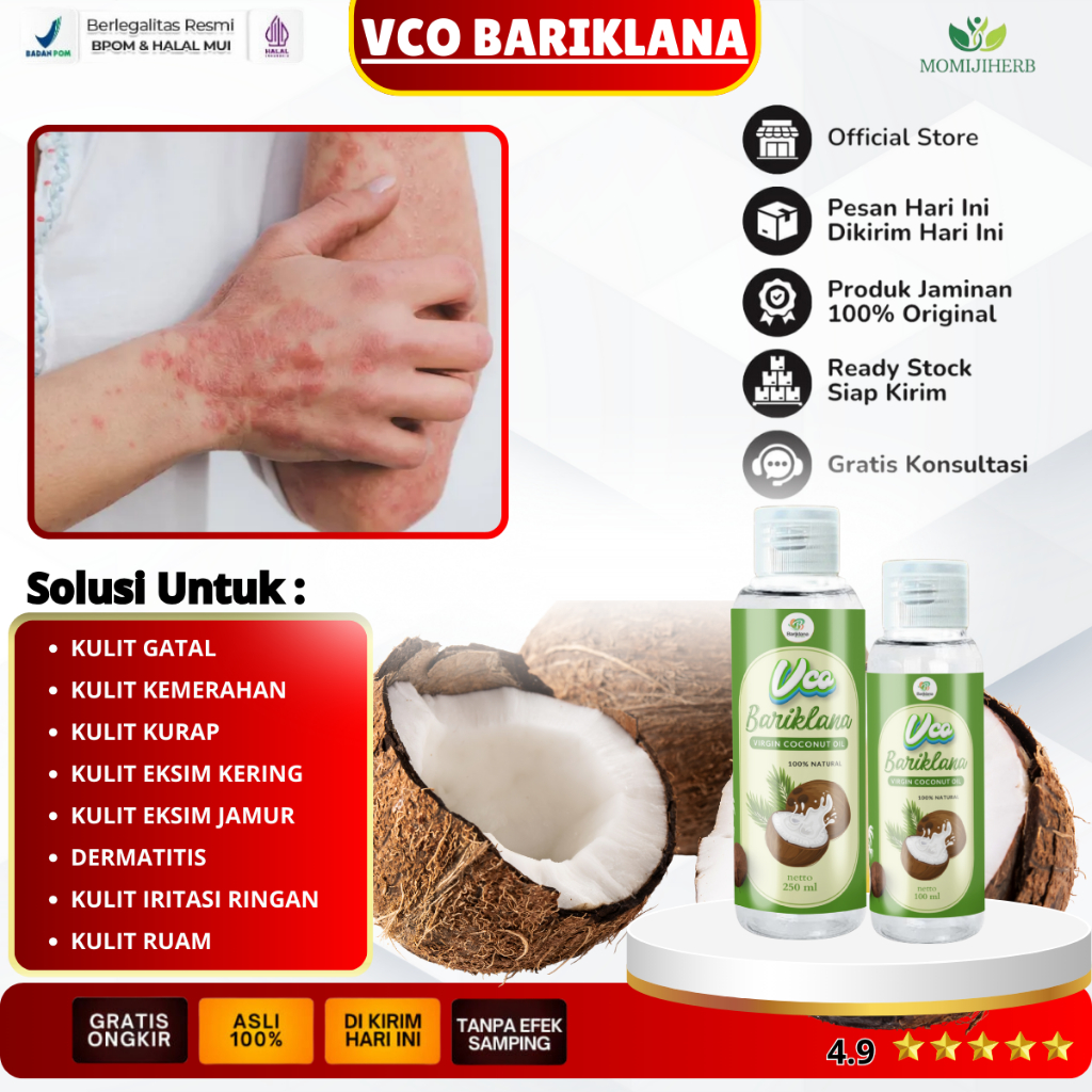Vco Bariklana Obat Eksim Jamur, Obat Eksim Kering Paling Ampuh, Obat Gatal Paling Ampuh, Obat Gatal 