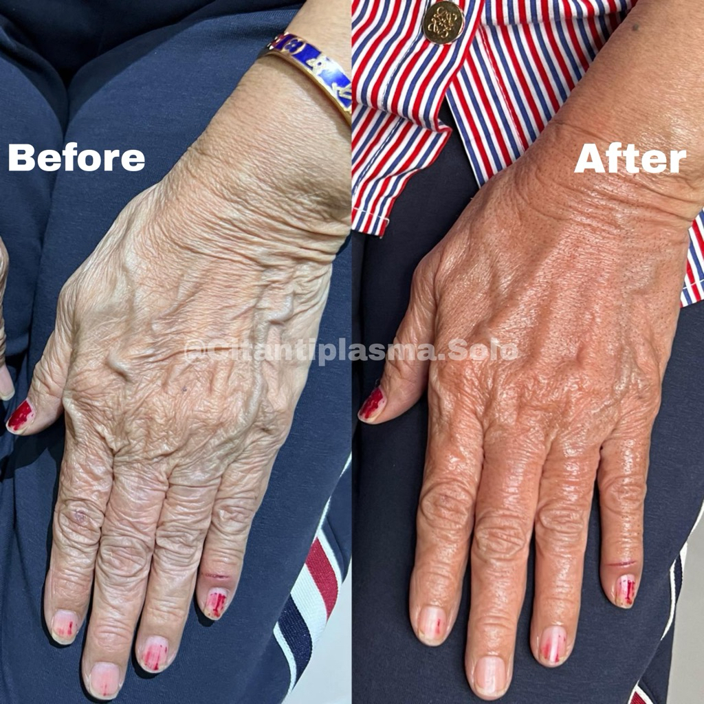 Plasma Fibroblast Hands Tightening