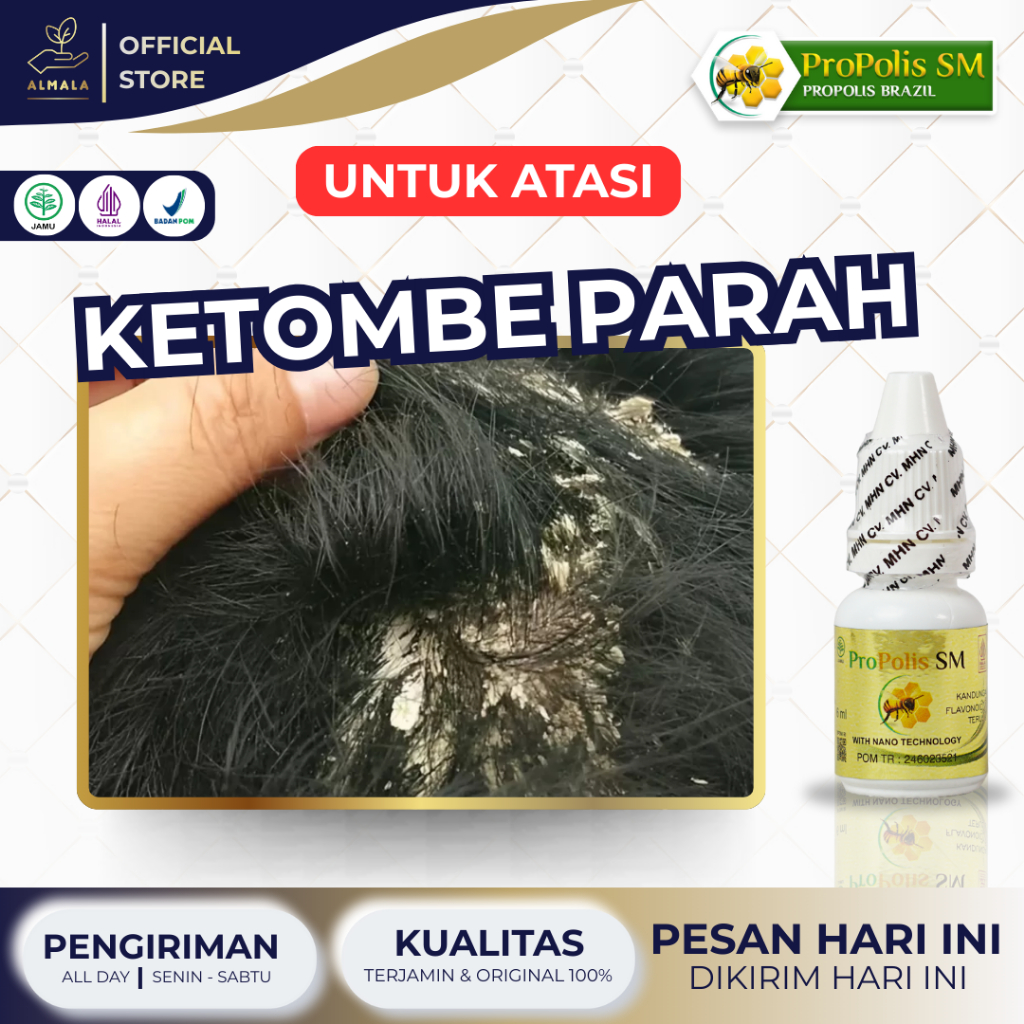 Obat Ketombe Parah, Ketombe Berkerak, Ketombe Membandel, Penghilang Ketombe, Psoriasis Propolis SM
