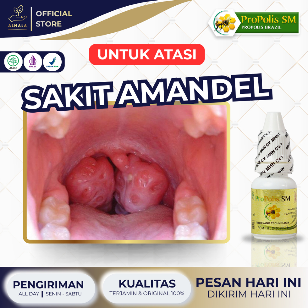 Obat Amandel, Radang Amandel, Amandel Anak & Dewasa, Amandel Bengkak, Bernanah, Berdarah, Radang Ten