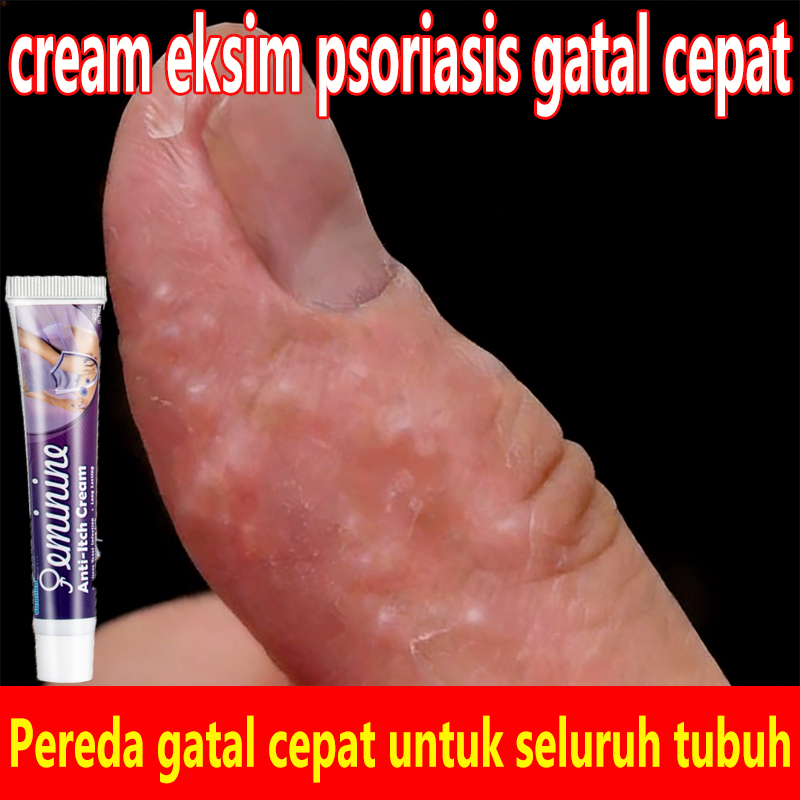 obat gatal selangkangan dan hitam salep eksim kering dan gatal salep jamur kulit paling ampuh salap 