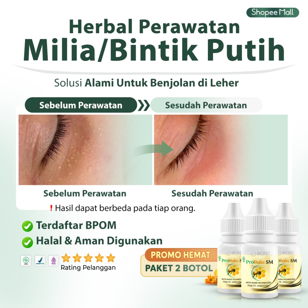 Obat Penghilang Milia Anak BPOM, Obat Bintik Putih di Milia Bawah Mata, Obat Milia pada Wajah, Obat 
