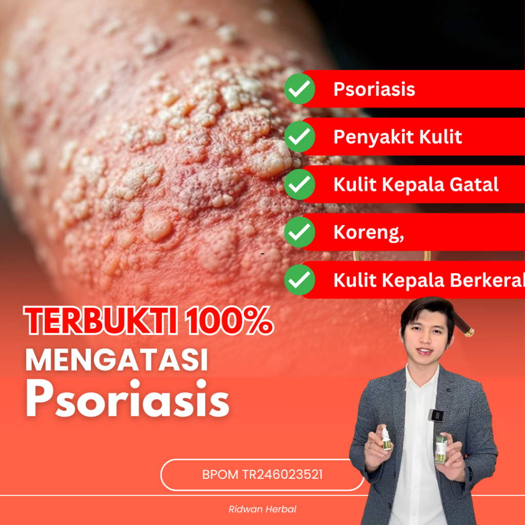 Obat Psoriasis - Obat Penyakit Kulit Psoriasis, Psoriasis Kepala, Gatal Psoriasis, Kulit Kepala Gata