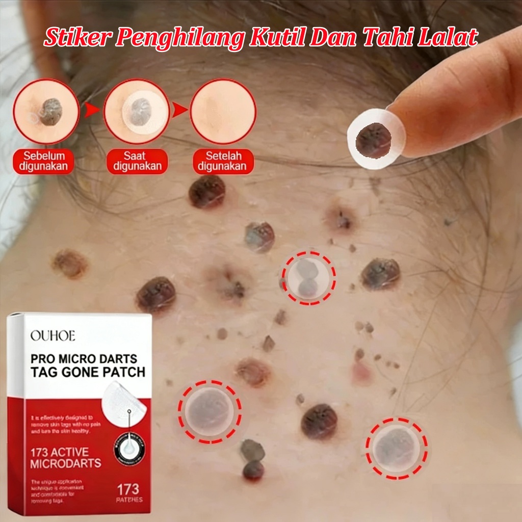 Stiker Penghilang Kutil di leher penghilang tahi lalat di wajah ampuh 144 PCS Mata Ikan Plester Kuti