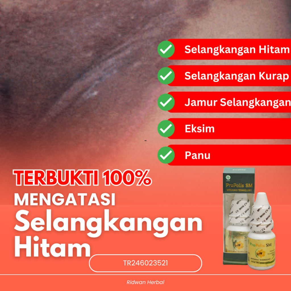 Propolis SM Obat Selangkangan Hitam dan Gatal, Obat Selangkangan Berjamur, Salep Jamur Selangkangan,