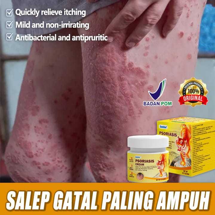 salep jamur kulit  RACIKAN JEPANG salep eksim salep gatal paling ampuh salep gatal 20g Kulit Kepala 