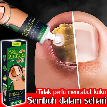 [100% Asli ] Anti Jamur Kuku Onikomikosis Paronychia Herbal Cina Obat kuku Obat jamur kuku Obat kuku