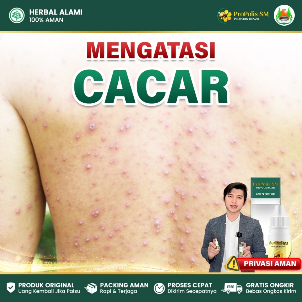 Obat Cacar Air, Cacar Api, Penghilang Bekas Cacar, Herpes Kulit, Cacar Monyet, Campak - Propolis SM