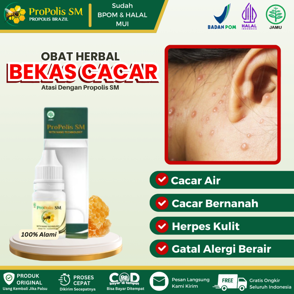 Obat Penghilang Bekas Luka Cacar, Cacar Air, Cacar Monyet, Cacar Api, Cacar Bernanah, Herpes Kulit, 