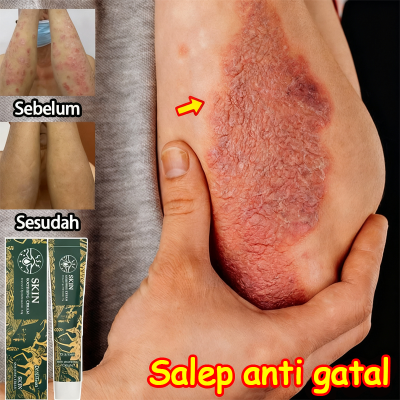 Obt Gatal Kulit Eksim Salap Gatal Kulit Yang Ampuh Salep Gatal Selangkangan Anti Jamur Psoriasis Sal