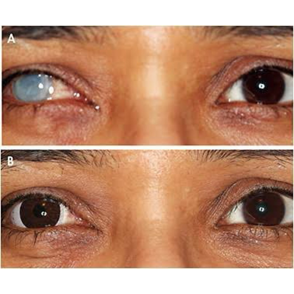 Lensa mata cacat Softlens prosthetic iris Lensa mata cacat menutupi iris putih dan pupil Softlen mat