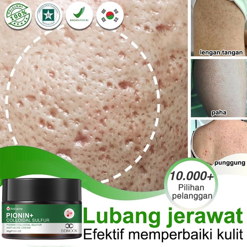 LYDIMOON Serum Asam Salisilat untuk Menghilangkan Jerawat, Krim Penghilang Bekas Jerawat, Salep Luba