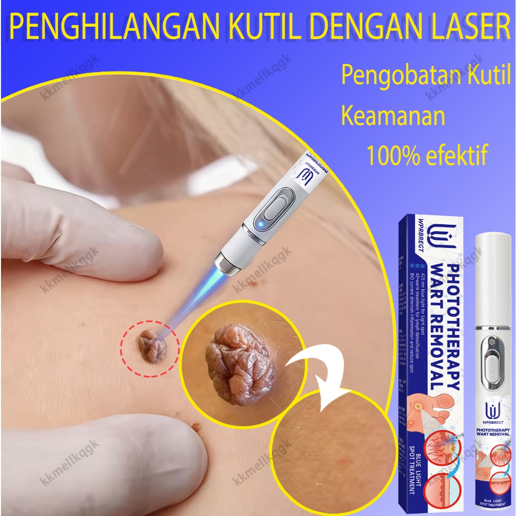 Pena Laser Plasma untuk Menghilangkan Tahi Lalat - Alat Penghilang Pertumbuhan Kulit, Flek Hitam, Pa