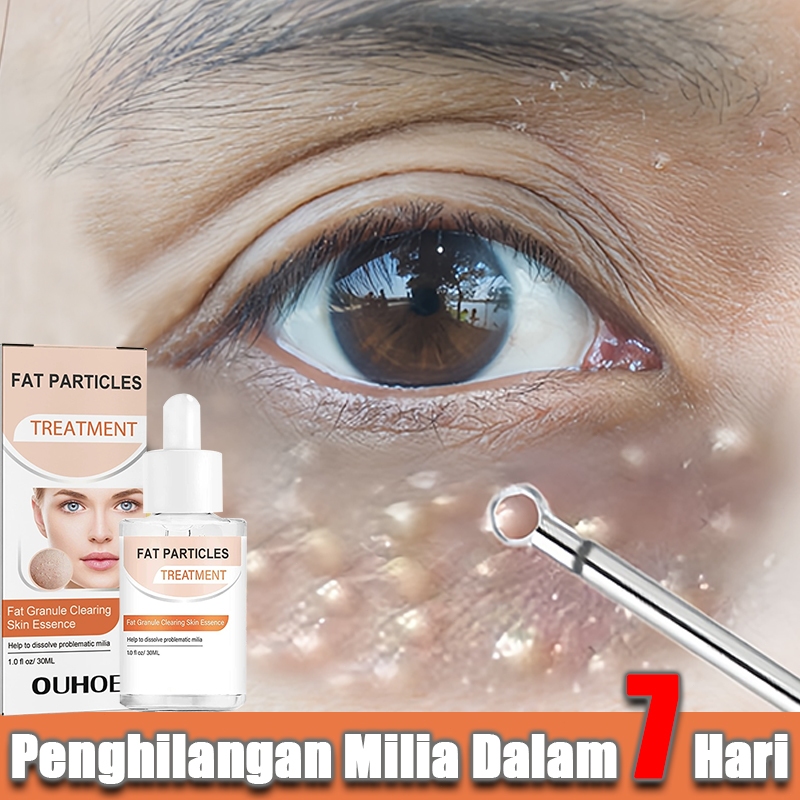 serum milia penghilang milia di bawah mata penghilang milia paling ampuh obat milia milia remover mi