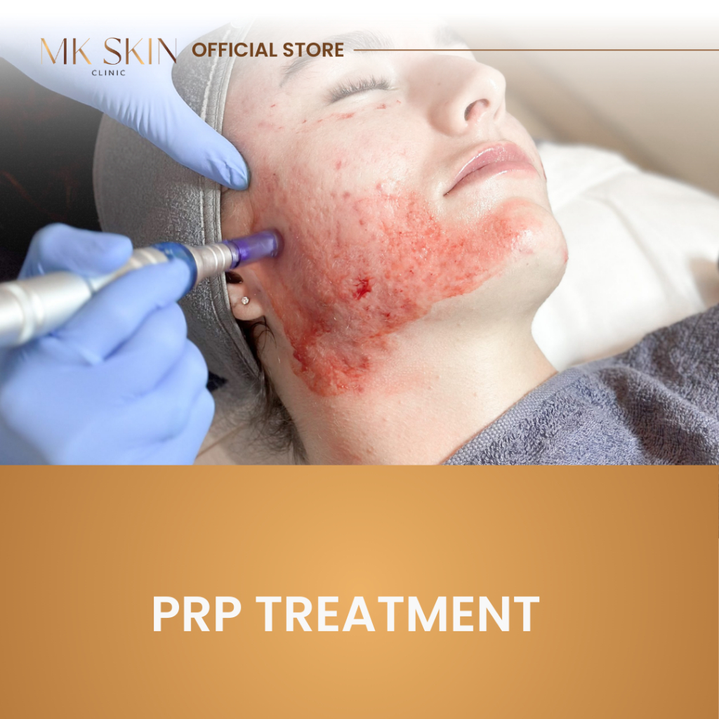 MKSKIN PRP TREATMENT