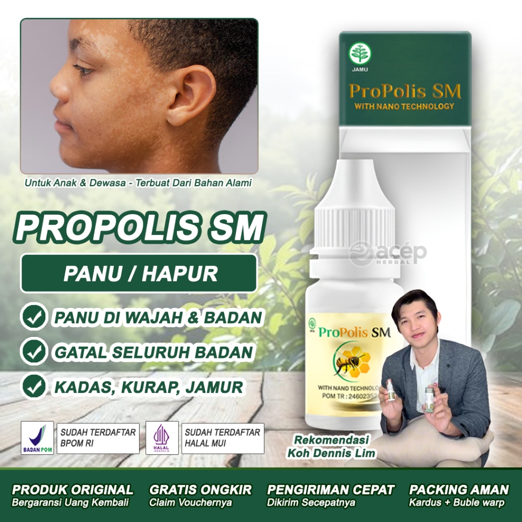 Obat Balas Bogo Penghilang Panu Di Wajah Dan Badan Bercak Putih Hapuran Kadas Kurap Gatal Gatal Kuli