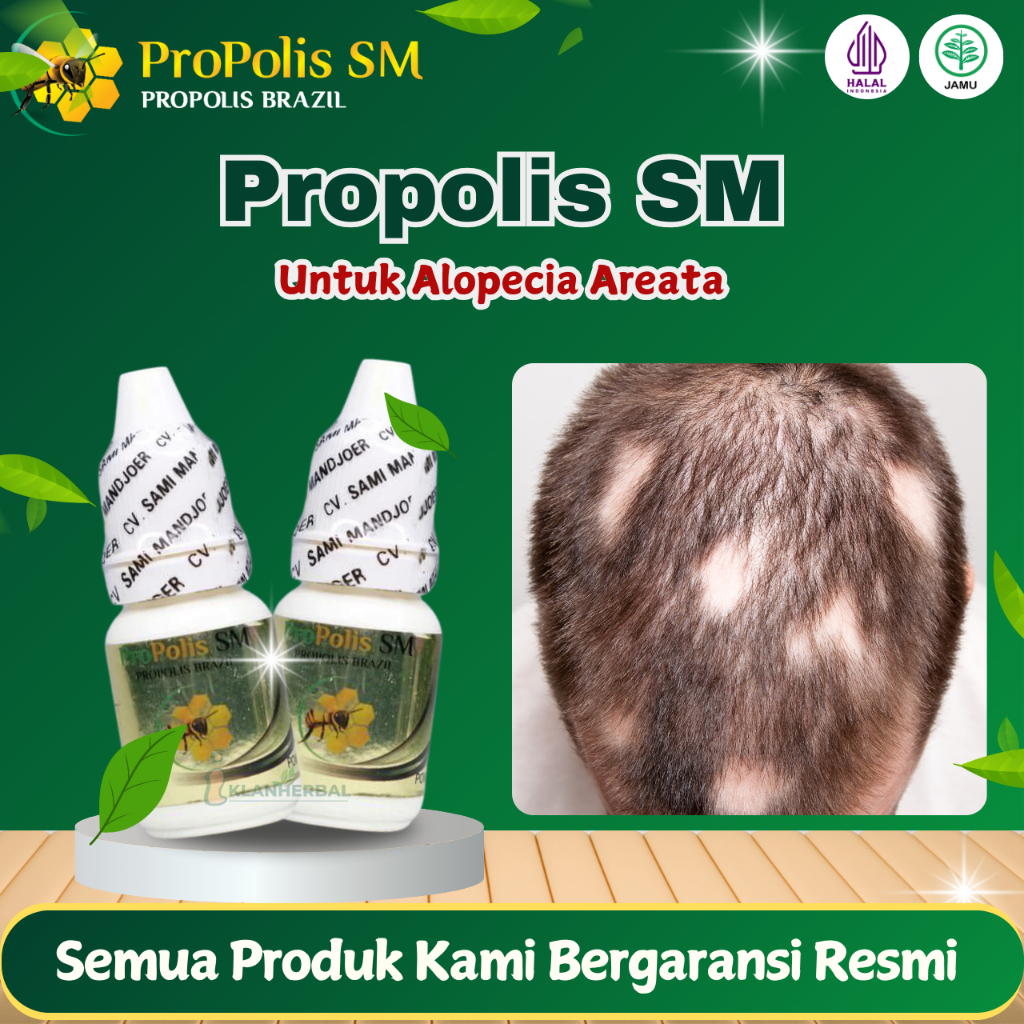 Propolis SM Obat Alopecia Areata, Penumbuh Rambut Pitak Botak, Psoriasis Kulit Kepala
