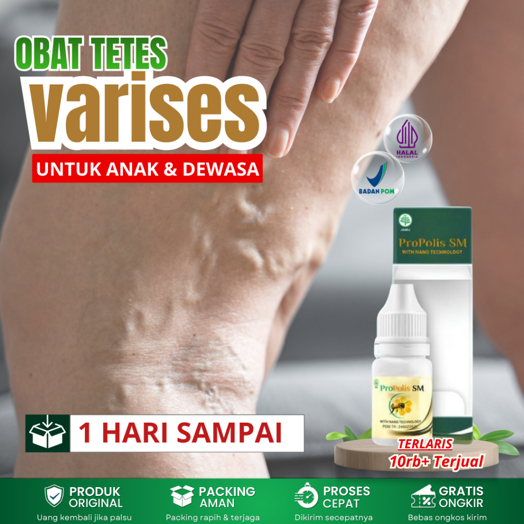 Obat Varises Di Tangan & Kaki, Penghilang Varises, Pelurus Urat Varises, Salep Penghilang Bekas Vari