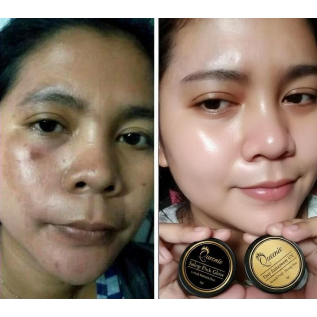 QUEENIE - Paket Siang Malam Salep Flek Glow 5gr | Ampuh Atasi Flek Hitam, Melasma, & Mencerahkan Waj