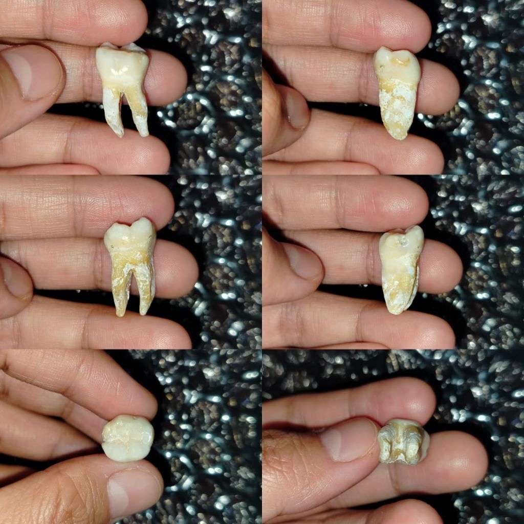 Gigi Molar 36