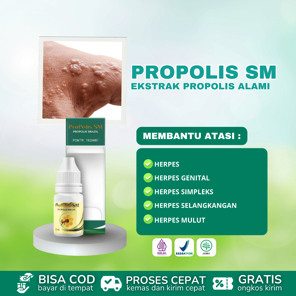 Obat Herpes, Herpes Kulit, Herpes Simpleks, Herpes Genital, Penghilang Herpes Kulit Pake Propolis SM