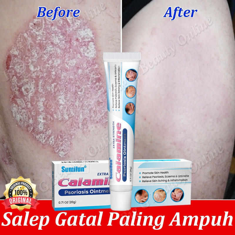 Salep Eksim Obat Gatal Selangkangan Salap Gatal Kulit Yang Ampuh Salep Gatal Selangkangan Psoriasis 