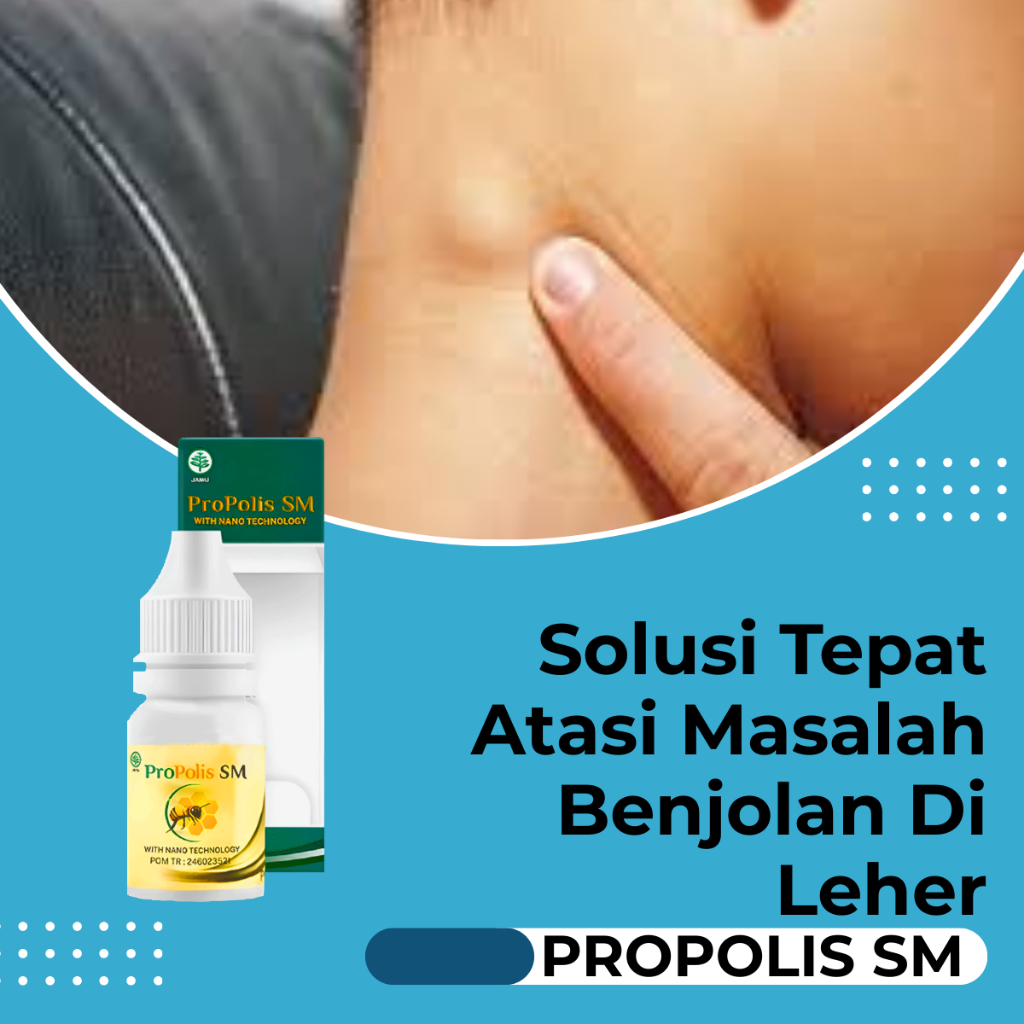 Obat Untuk Benjolan Di Leher, Benjolan Di Tangan, Benjolan Tiroid, Kelenjar Getah Bening - Propolis 
