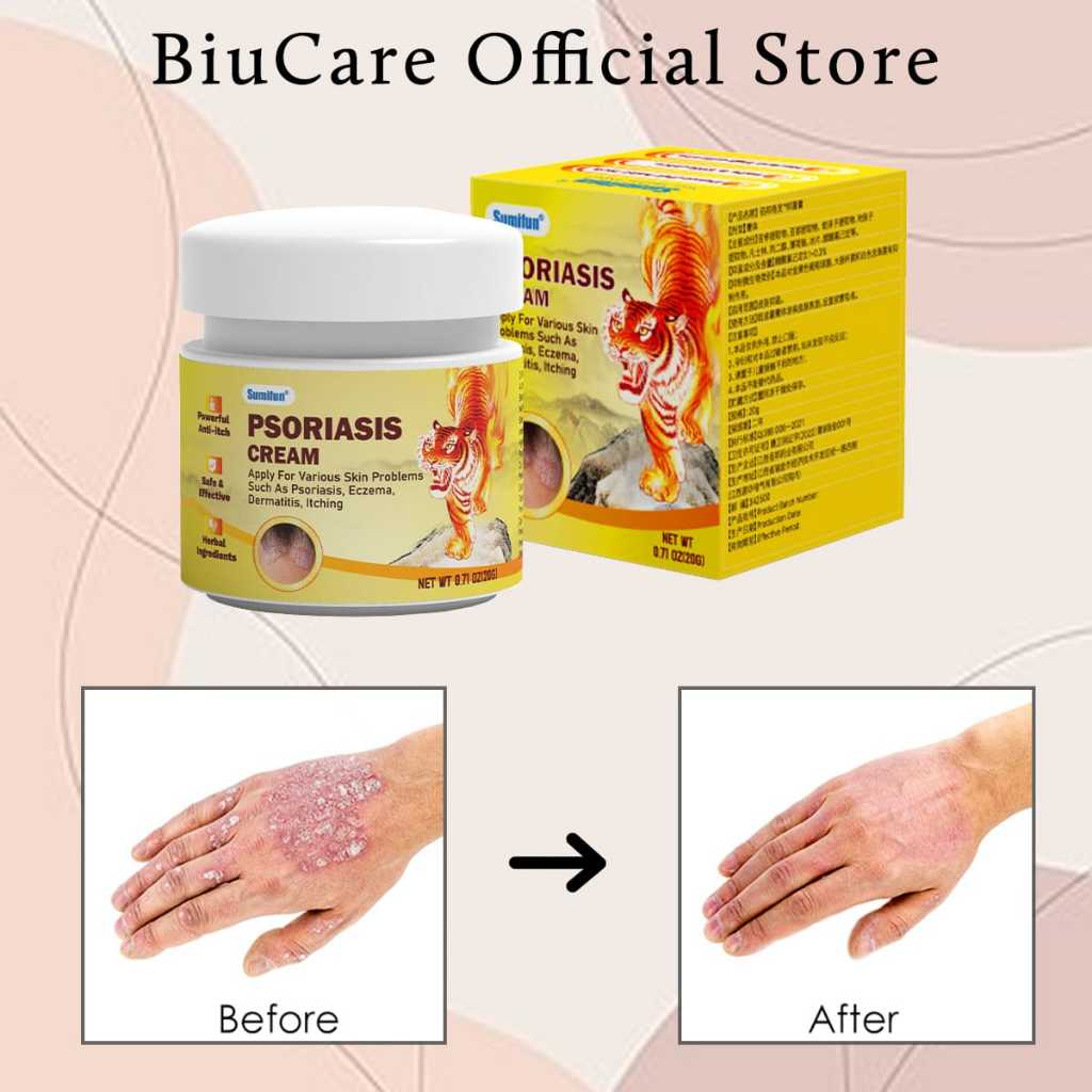ORIGINAL Obat gatal Obat eksim Obat kurap RACIKAN JEPANG Salep psoriasis Salep eksim 20g Obat kurap 