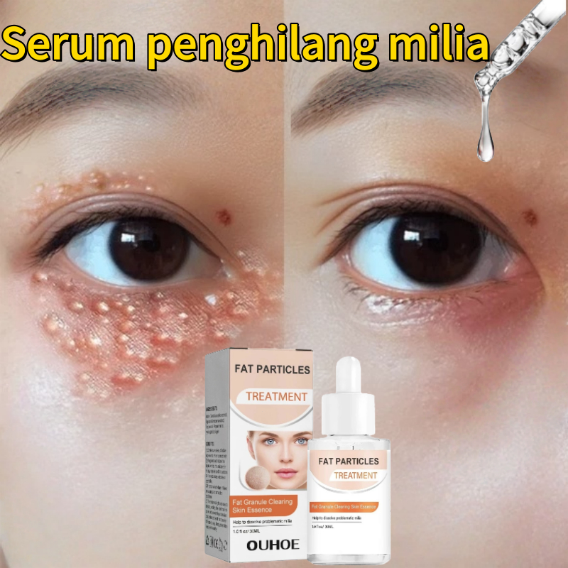Obat milia Penghilang milia paling ampuh Milia di bawah mata Serum milia Butiran Lemak Sekitar Mata 