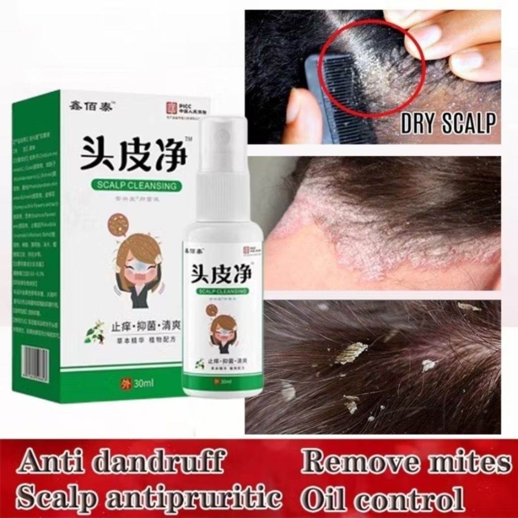 [FREE GIFT] Obat Ketombe Paling Ampuh Obat Ketombe Membandel dan Gatal Kulit Kepala Permanen